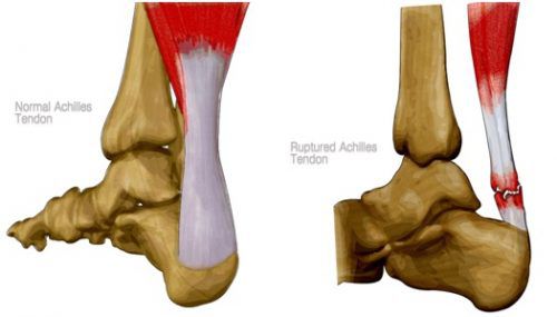 Ρήξη Αχίλλειου Τένοντα - Τομείς Εξειδίκευσης Παθήσεις Ποδοκνημικής & Άκρου Ποδός - Ελευθέριος Καραδήμας Ορθοπαιδικός Χειρούργος