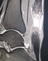 Ρήξη Αχίλλειου Τένοντα - Τομείς Εξειδίκευσης Παθήσεις Ποδοκνημικής & Άκρου Ποδός - Ελευθέριος Καραδήμας Ορθοπαιδικός Χειρούργος