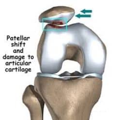 Χονδροπάθεια επιγονατίδας - Τομείς Εξειδίκευσης Ελευθέριος Καραδήμας Ορθοπαιδικός Χειρουργός